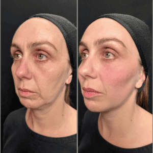 Sculptra Treatment
