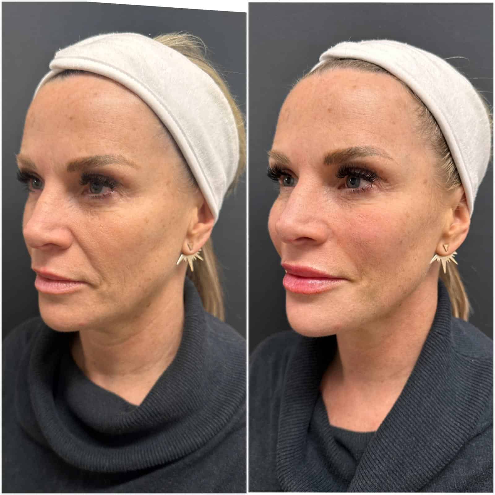 before and after - sculptra and skinboosters