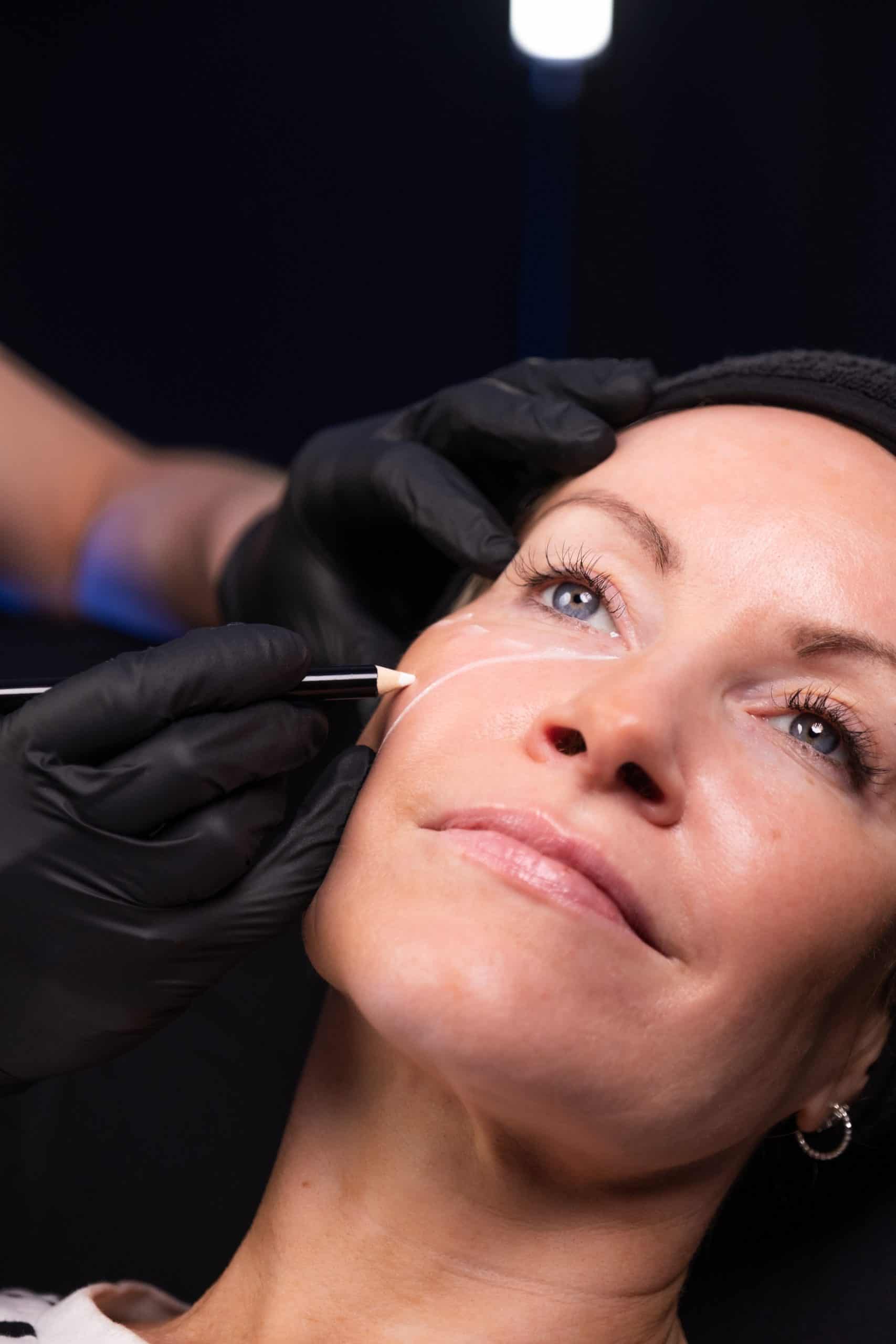 Botulinum Toxin Injection Sites