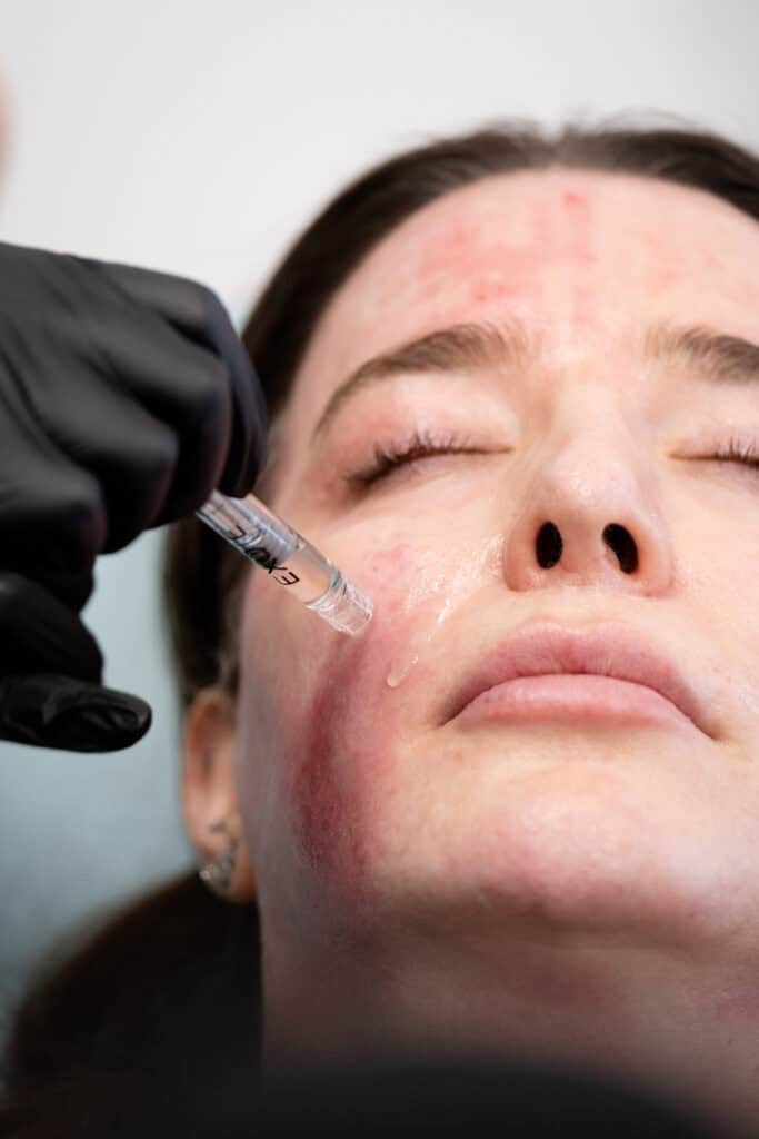 Microneedling EXOIE